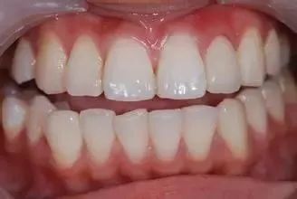 氧化锆全瓷牙的缺点和优点,牙医建议烤瓷不建议全瓷