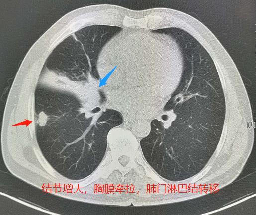 5个小故事：肺结核、脑梗死、车祸，这些意外发现的肺癌都能治
