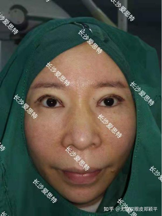 刚割双眼皮的样子,割双眼皮增生是什么样子