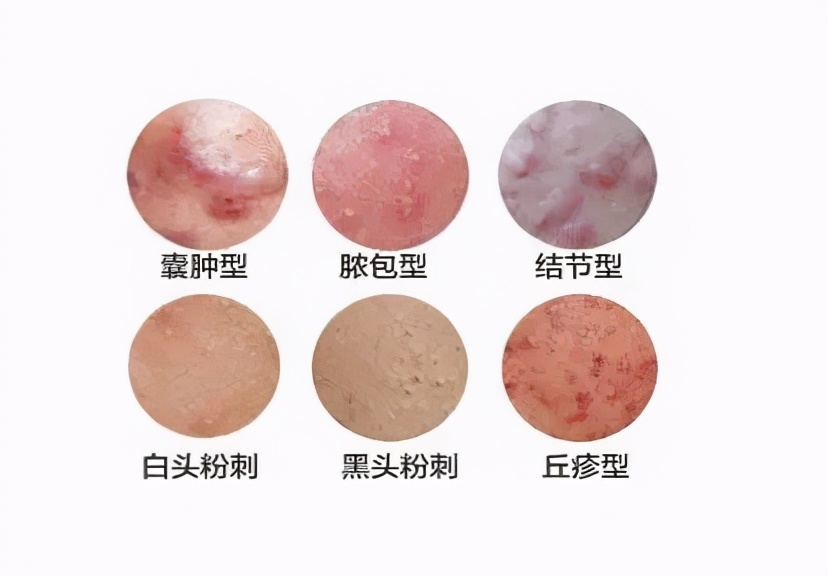 中医治疗痘痘真的有用吗,等离子杀菌对人体有害吗