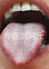 小便涩痛，尿道口发热，口干眼涩，属湿热淋证，首选八正散加减