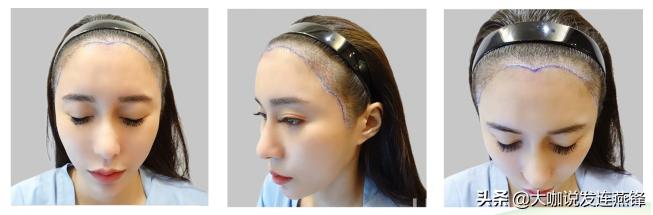 2500单位发际线,2000单位植发