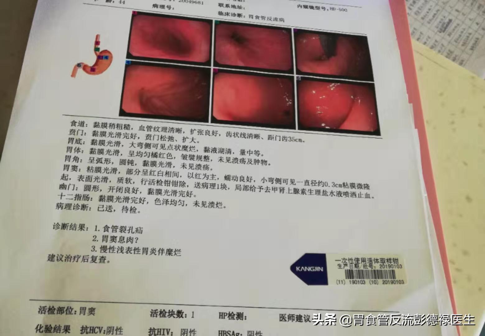 胃胀打嗝嗓子痛吃中药能治吗,嗳气多咽痛是什么原因