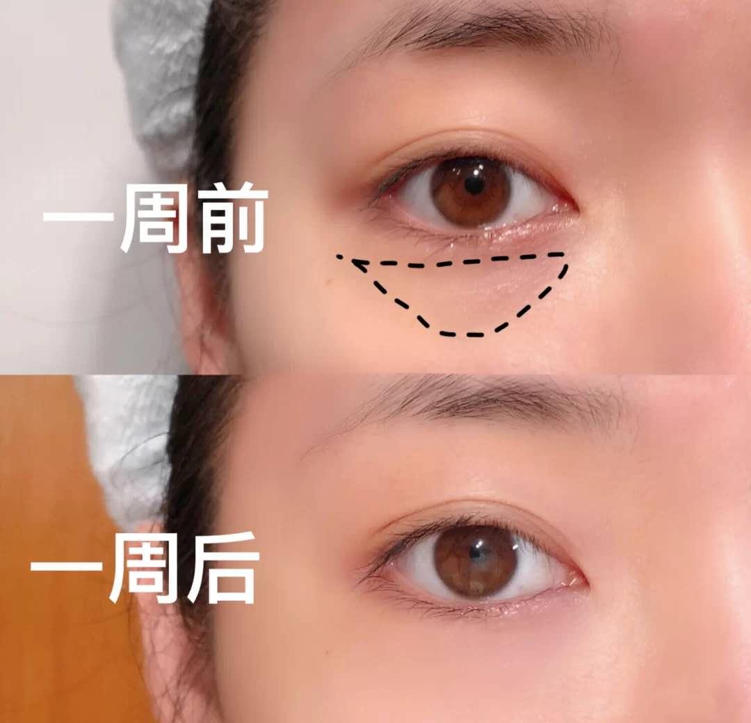 眼部最近出现了细纹怎么办,眼部细纹突然多