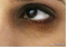 长期熬夜黑眼圈很重,长期熬夜导致的黑眼圈怎么办