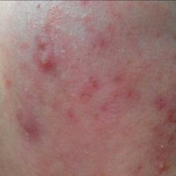 抖音别来无恙,痘印走开对付痘印的正确方法