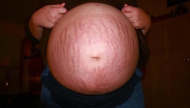 妊娠纹如何修复最好,如何预防以及缓解妊娠纹