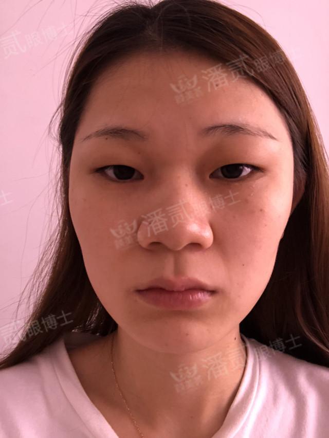 什么样的肿眼泡适合全切,什么样的肿眼泡不用动提肌