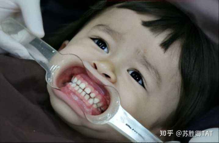 记录我的牙套日记,牙套日记日常