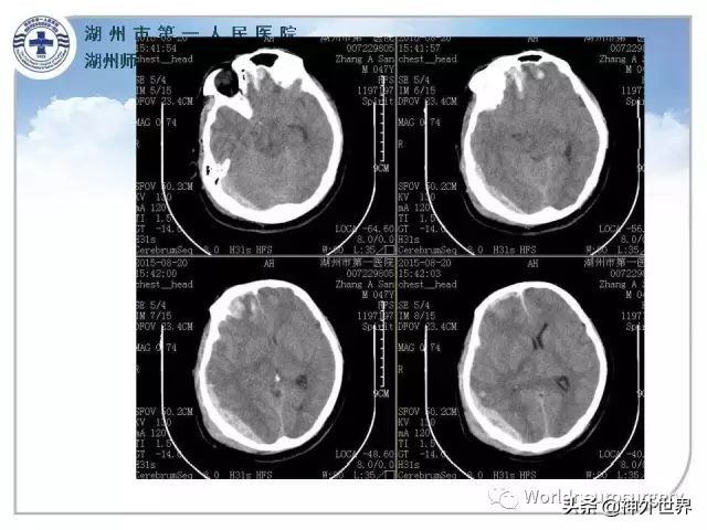 头皮裂伤缝合手术切口分类,头皮切口