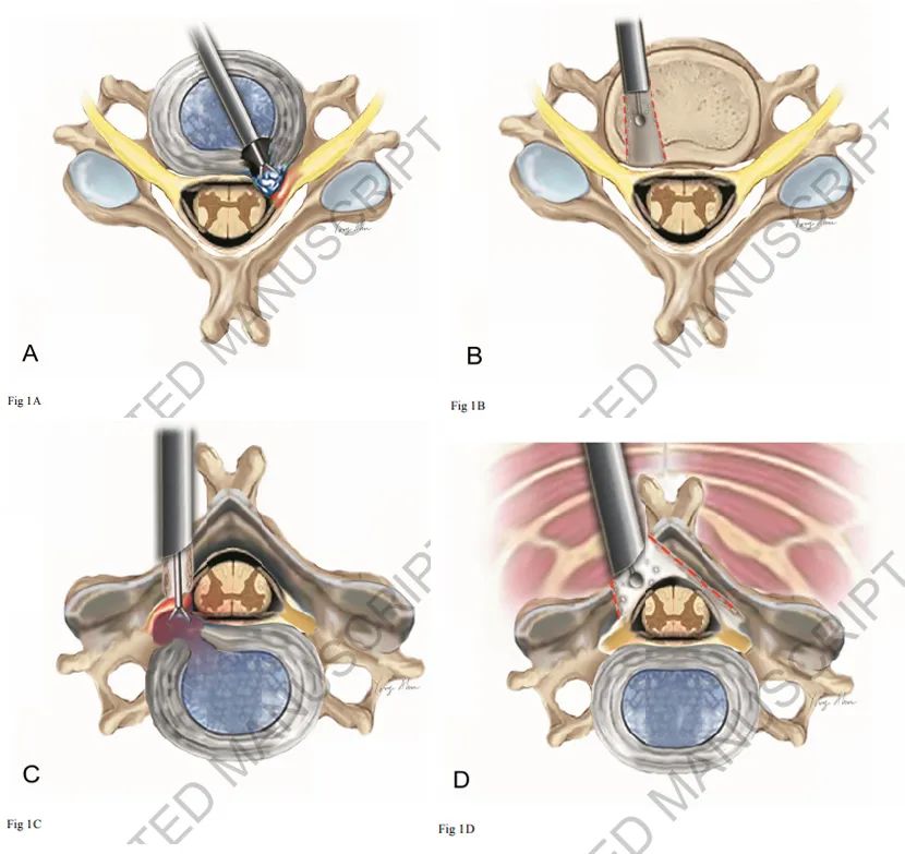 颈椎内窥镜手术效果,颈椎病内窥镜手术