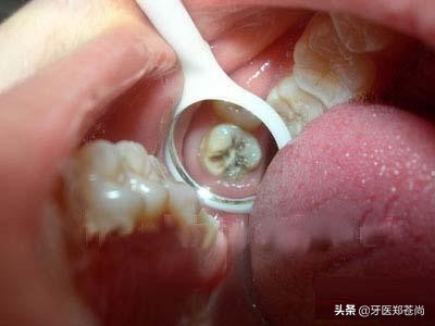 蛀牙疼不疼,蛀牙根管治疗疼不疼