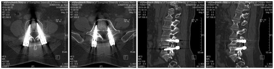 椎间盘突出和椎管狭窄症状的区别,腰椎管狭窄症的症状