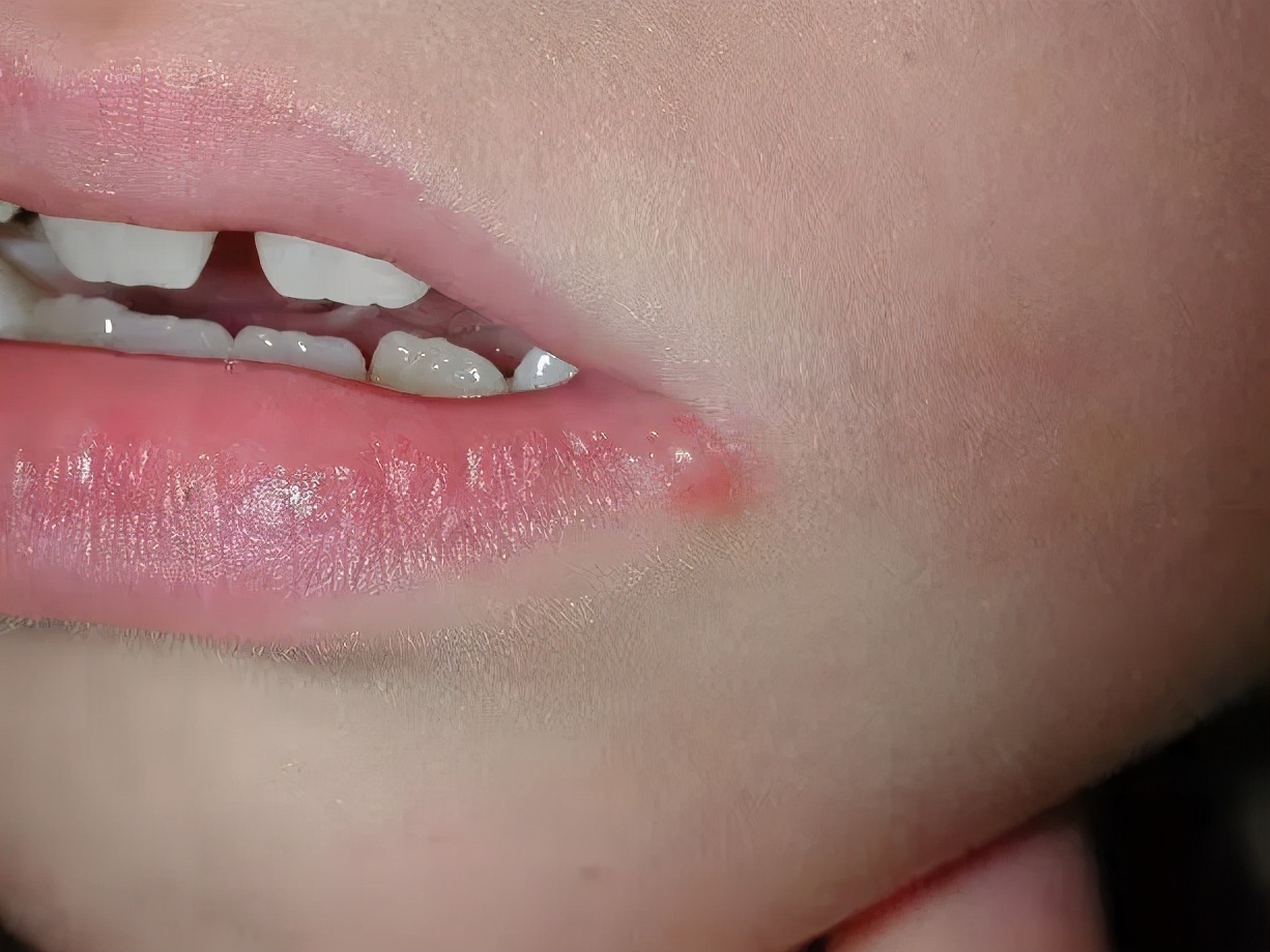 2岁儿童全身长小水泡,2岁小孩一边嘴角长小水泡