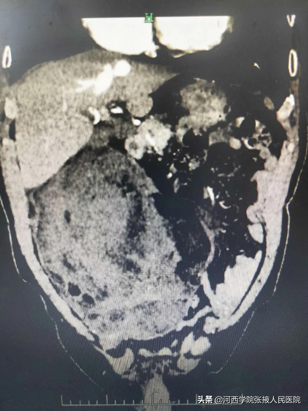 80多岁腹膜后肿瘤,高龄腹腔良性肿瘤手术风险