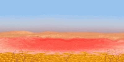 痘肌女孩必看!你想要了解的油痘肌医美项目都在这里了