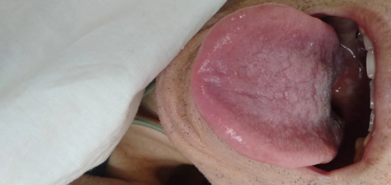 中西医结合治疗原因不明肠梗阻、腹水转氨酶明显升高病案一例！