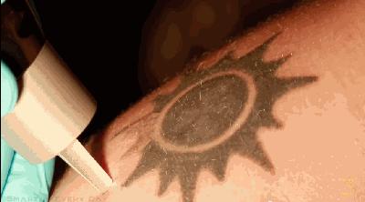 激光祛纹身的正确方法,激光快速祛纹身方法