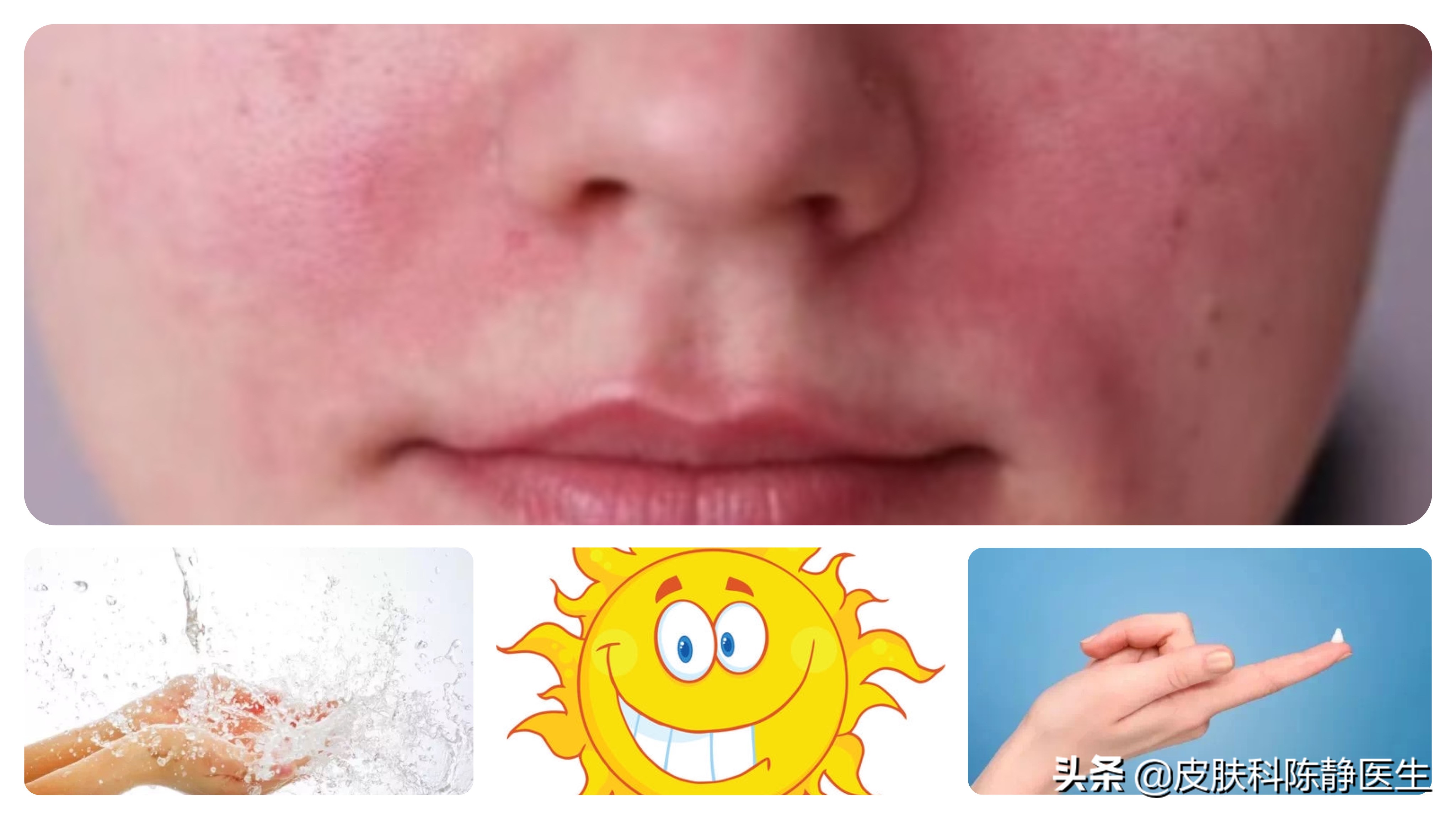 玫瑰痤疮只要戒腥辣就不会长了吗,玫瑰痤疮控制炎症可以输液吗