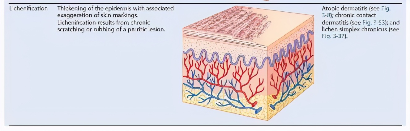 手上长一片小疙瘩还痒是怎么回事,天一热手上就起一层小疙瘩还很痒