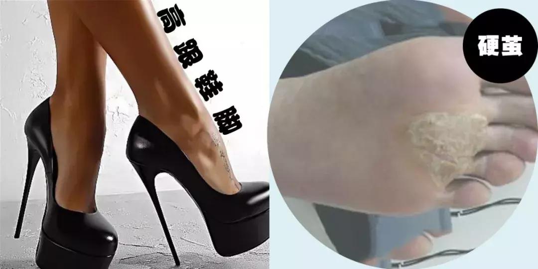 脚拇外翻怎么办教你一招,你的脚好丑的意思