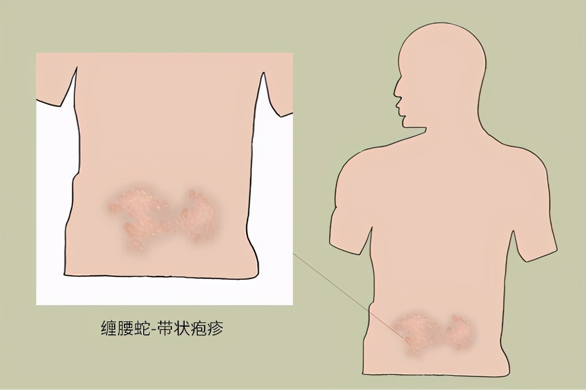 蛇盘疮患者能不能洗澡,长了蛇疮需要休息吗