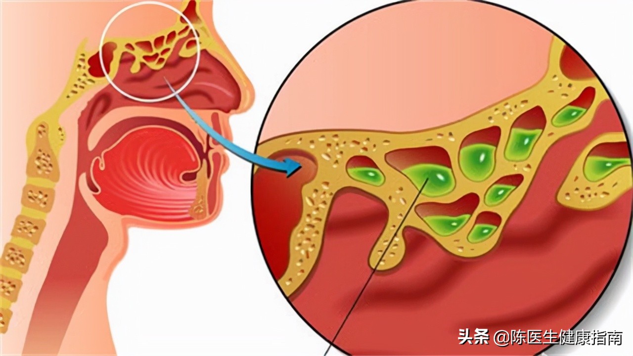 阿莫西林消炎药属于抗生素不,阿莫西林并非万能药