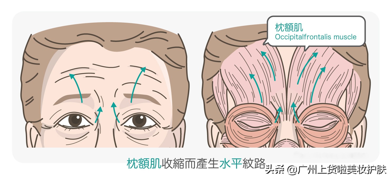 一招解决抬头纹的方法,跟抬头纹说拜拜