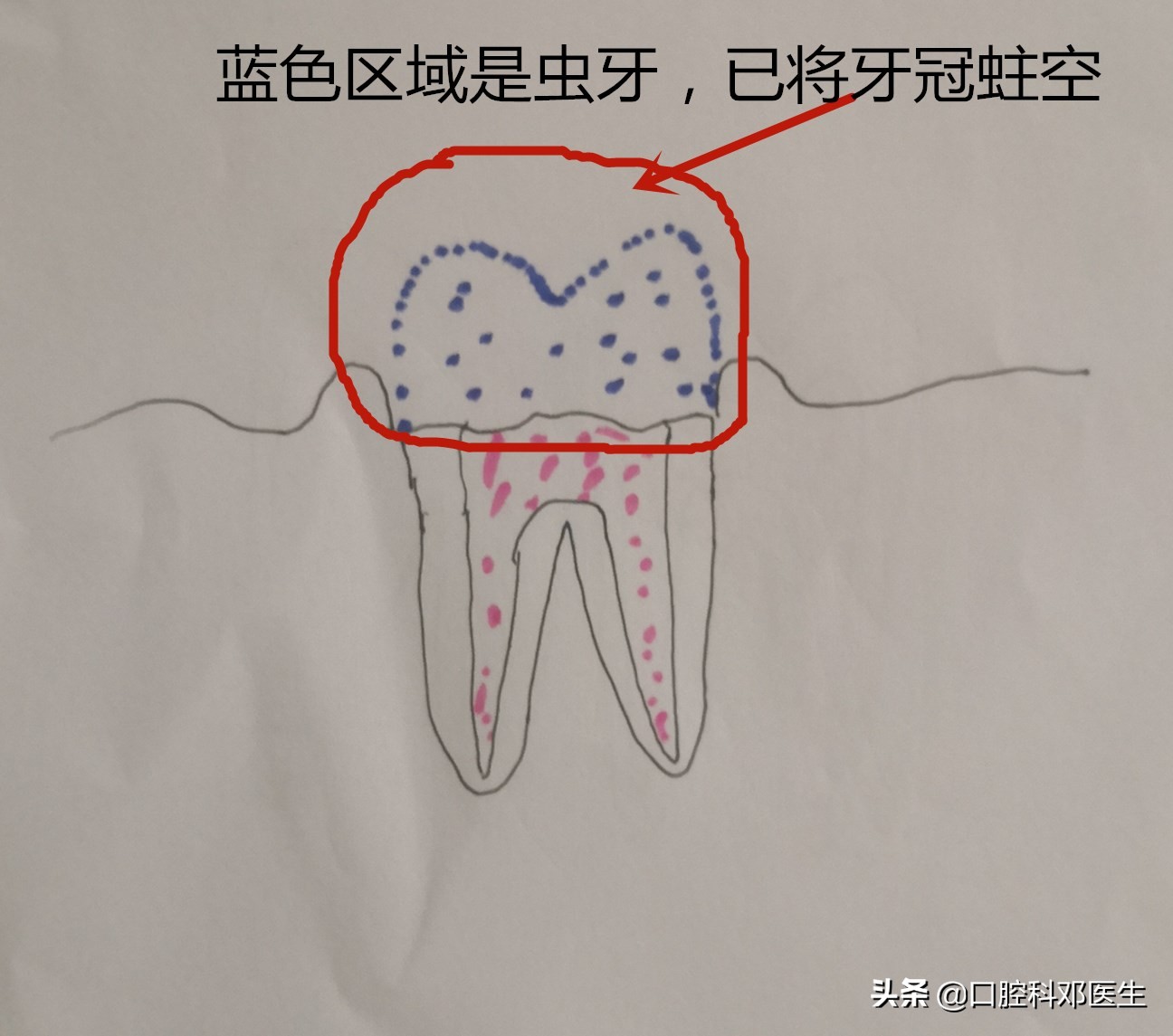 虫牙不及时补有什么后果,虫牙不治疗直接补能管多久