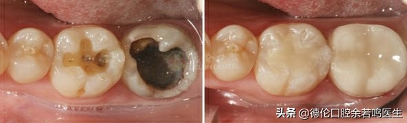 里面的牙如何修复,现在哪里有修复牙齿的