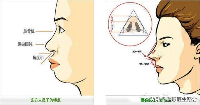 鼻子是怎么垫高的,鼻子垫高点更完美了