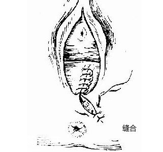 顺产什么情况会被侧切,顺产时候啥情况会引起大出血