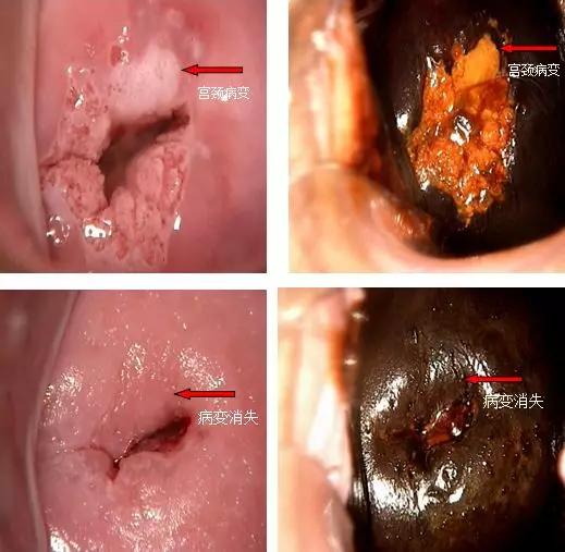 注意！告诉您一个可以治疗宫颈病变且不影响生育的好办法