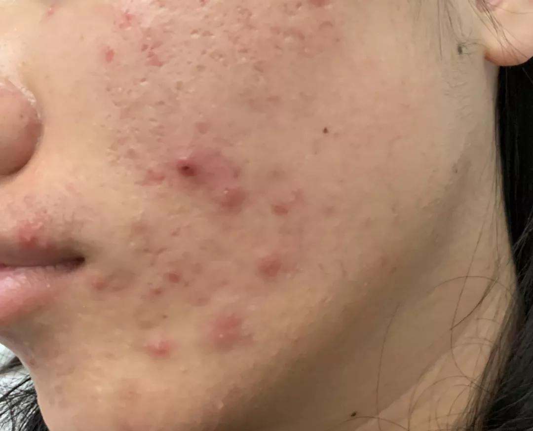 治痘痘维a酸类药膏哪个好,异维a酸胶囊可以永久治好痘痘吗