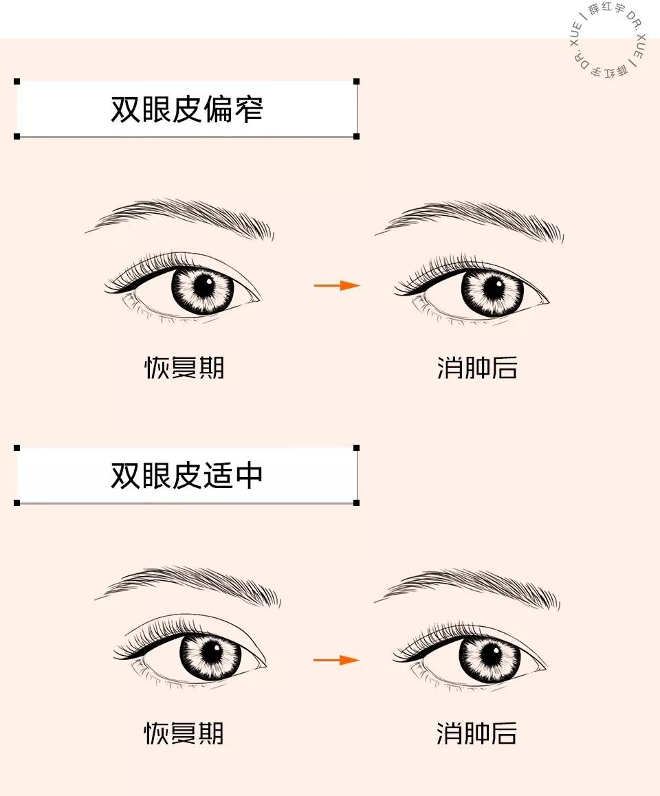 那些要求双眼皮术后效果立竿见影的姑娘们，后来怎么样了？