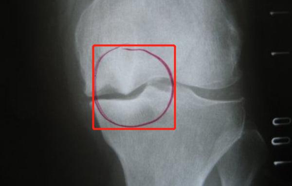 长骨刺吃多长时间的药能治好,骨刺早期都开始治疗能治好吗