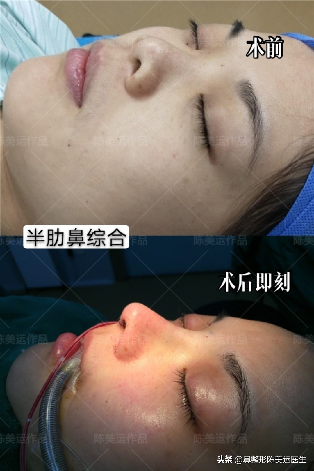 塌鼻子怎么能变成尖鼻子,鼻子太窄太小是不是很难增高鼻梁