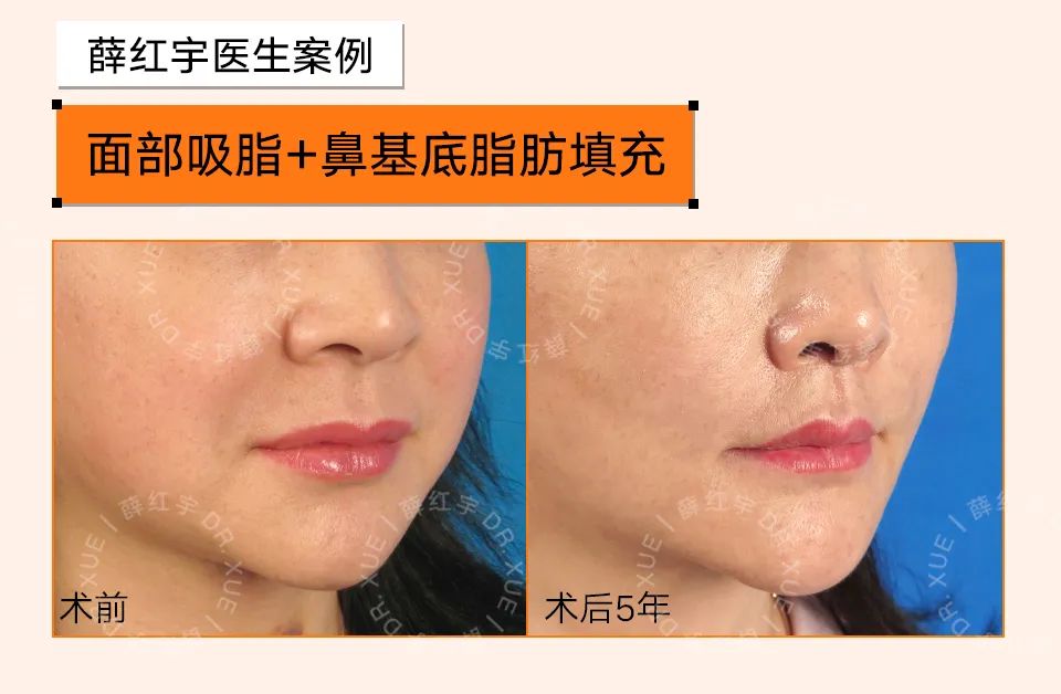 脾胃好了法令纹会改善吗,面部瑜伽能改善法令纹吗