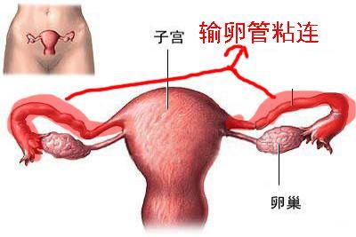 输卵管粘连还能自然受孕吗,输卵管粘连还能自然怀孕吗