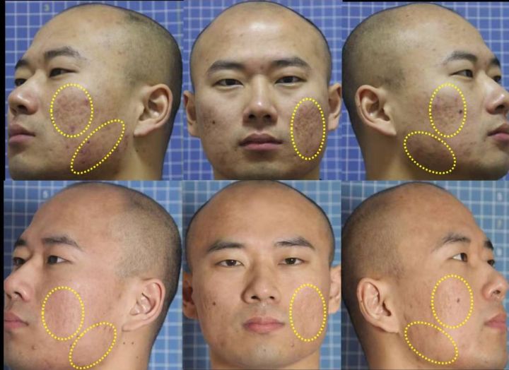 昆明祛除痘印痘坑,如何祛除痘印痘坑效果好