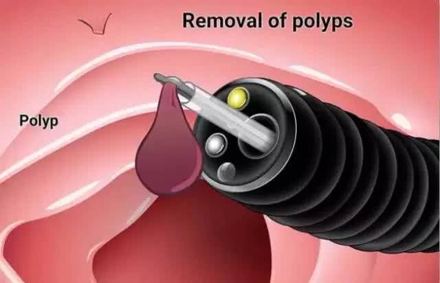 引发肠息肉原因有哪些,肠息肉早期症状有腹痛腹胀现象吗