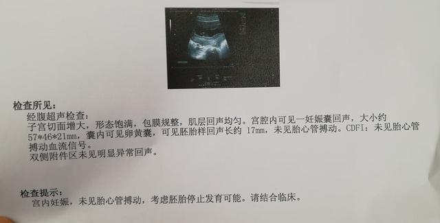 稽留流产超声表现,稽留流产什么意思