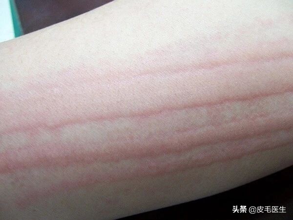 人工划痕症是顽固皮肤病吗,人工划痕症稀有吗