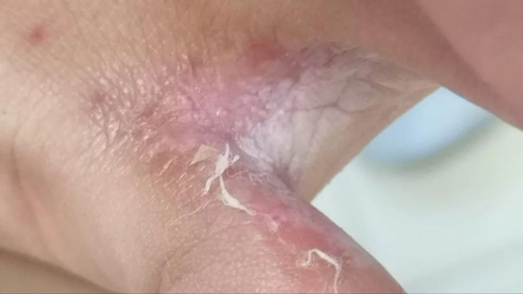 脚上干裂居然是真菌惹的祸