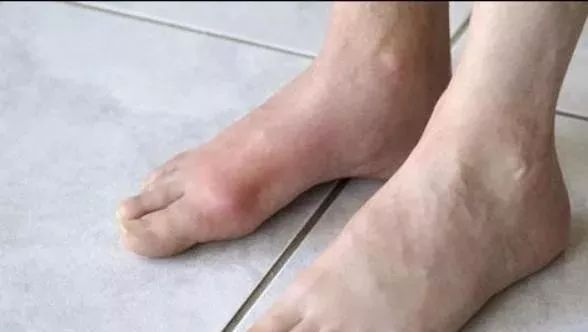 脚部一旦出现这3种情况,什么病会在脚部出现症状
