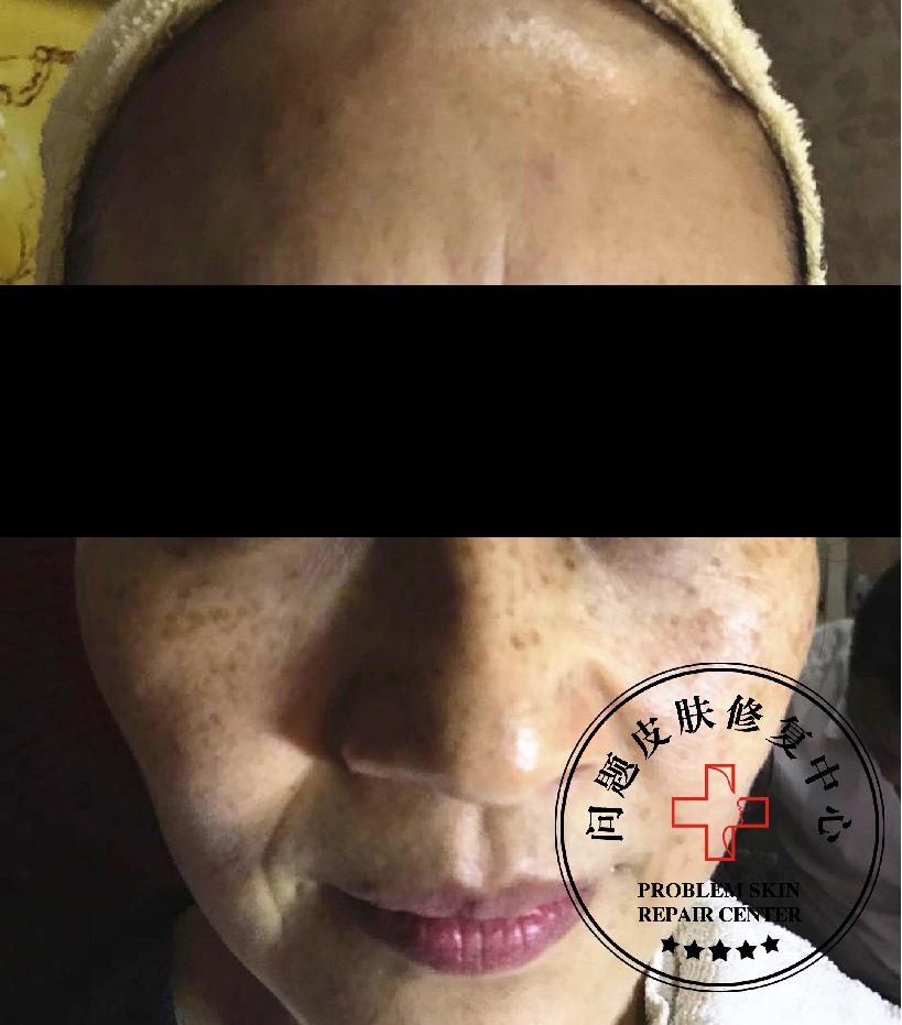 激光祛斑反黑修复过程,st修复祛斑最佳方法