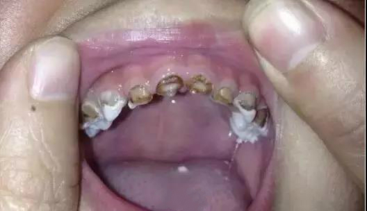 小黑点的蛀牙不严重吗,蛀牙了一点点黑色也得补么