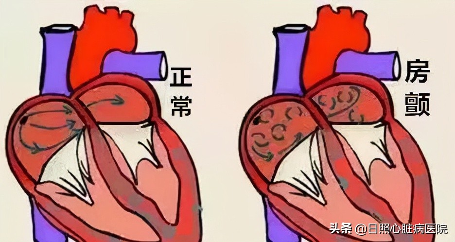 心房颤动有什么危害,心脏你了解多少