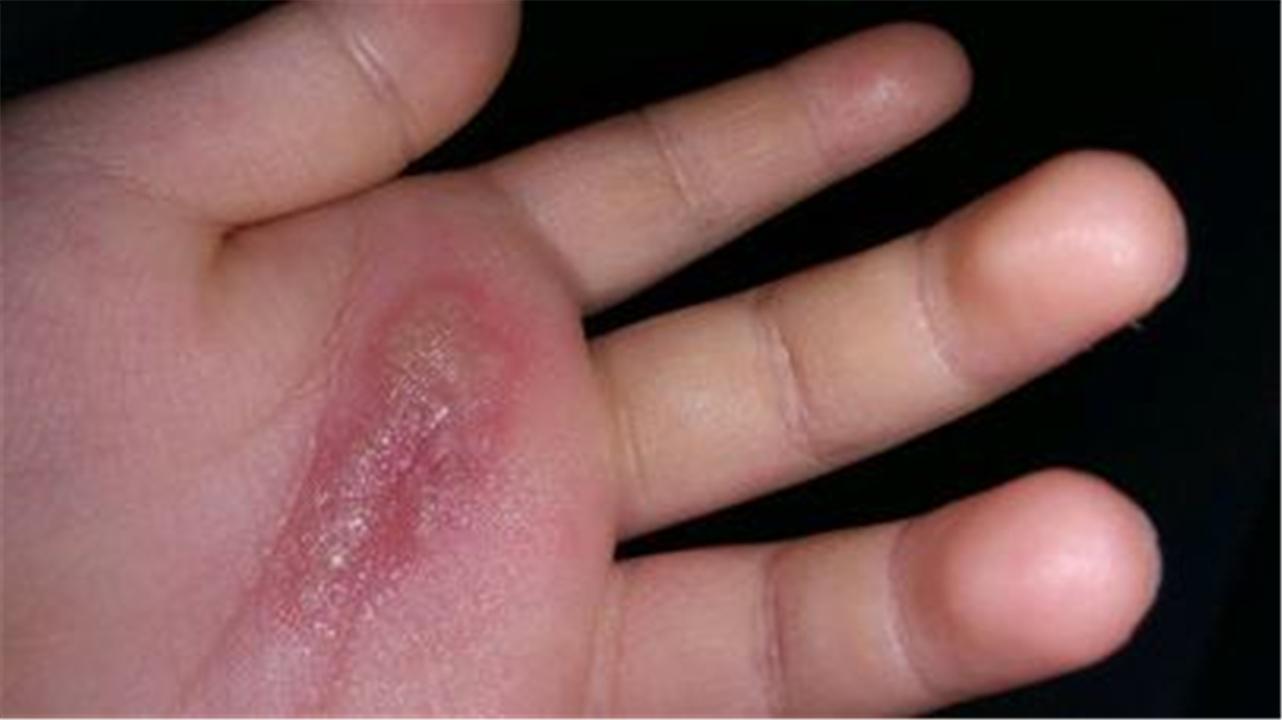 儿童不小心被烫伤用什么药膏,孩子被烫伤的黄金怎么处理