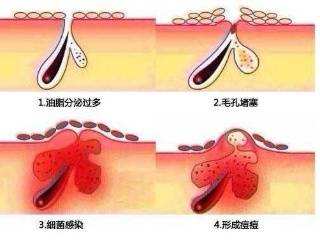 “毛孔”大作战！抓紧时间行动起来~